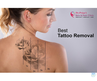 Best Laser Tattoo Removal in Bangalore - Guaranteed Results