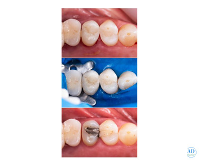 Premium Dental Filling Material by The Smile Spa – Safe, Durable & Ideal for Dental Clinics