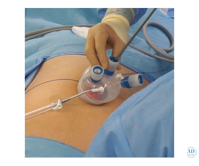 Single Port Laparoscopic Surgery in Mumbai