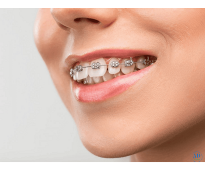 Best Orthodontic Braces in Ghaziabad – Dr. Khan Clinic