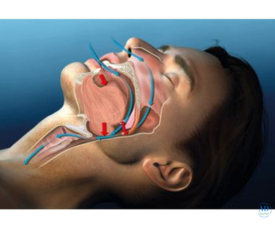 Snoring Treatment in Qatar