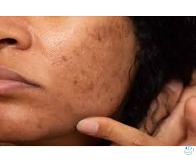 Rejuvenate Your Skin Naturally with PRP Treatment