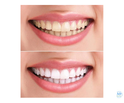 Teeth Whitening in Thane | Brighten Your Smile at Creative Smiles