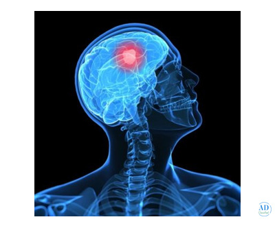 Best Neurosurgery Hospital in Chennai | Expert Neurosurgeon