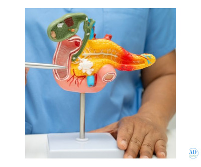 Best Pancreatic Surgeon in India: Specialized Care for Pancreatic Disorders