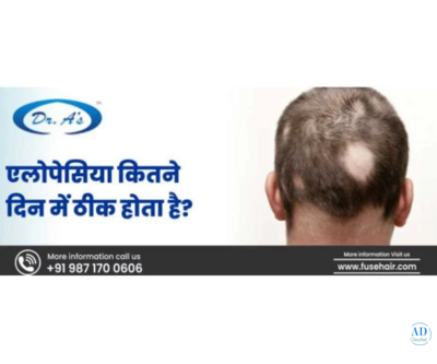 Alopecia Theek Hone Mein Kitane Din Lagate Hain