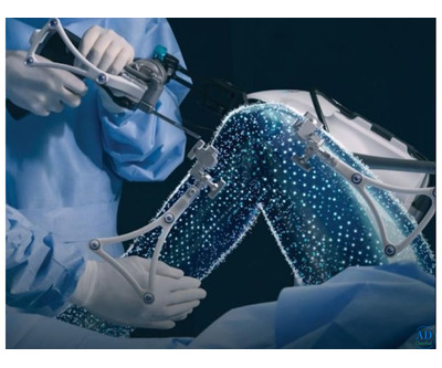Robotic-Assisted Total Knee Replacement in Ahmedabad by Dr. Ajaysinh Devda