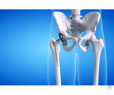 Revision Hip Replacement by Dr. Ajaysinh Devda