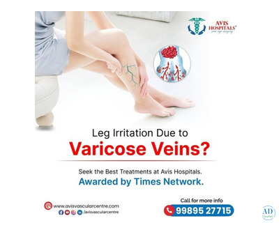 Varicose Veins Treatment