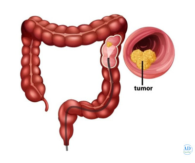 Expert Colon Cancer Treatment in Ahmedabad:Dr Nitin Singhal