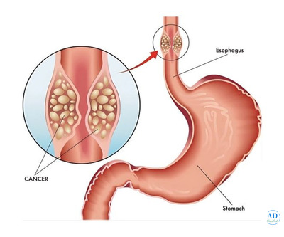 Expert Robotic Esophageal Cancer Surgeon in Ahmedabad for Precise Care