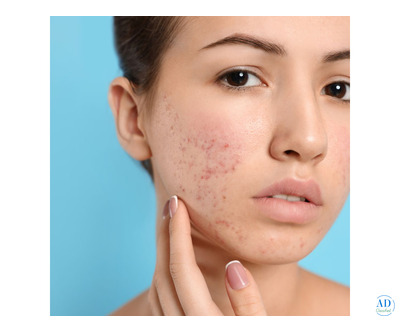 Clear Skin, New Confidence: Acne Scar Treatment in Mumbai
