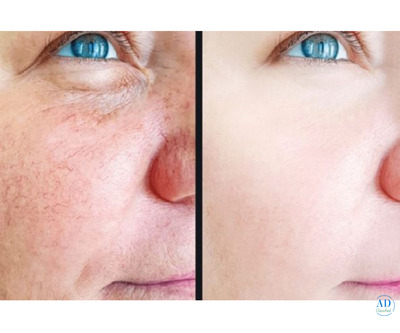 Laser Hair Removal In Toronto | Distill Laser Clinic