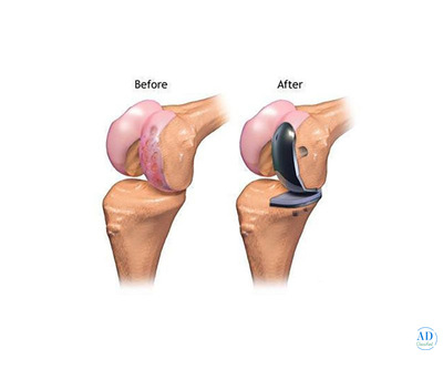 Partial Knee Replacement Surgery in Punjab | Elite Orthopaedics