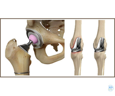 Revision Knee & Hip Replacement Surgery | Elite Ortho India