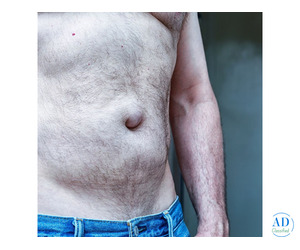 Best Hernia Surgeon in India: Expert Surgical Solutions
