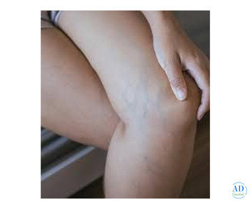 Best Hospital for Varicose Vein Treatment in India – Advanced & Painless Care