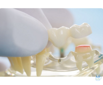 Capping of Tooth in Vikaspuri – Expert Dental Care for a Stronger Smile