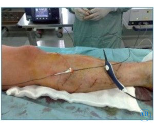 Discover the Best Hospital for Varicose Vein Treatment in India