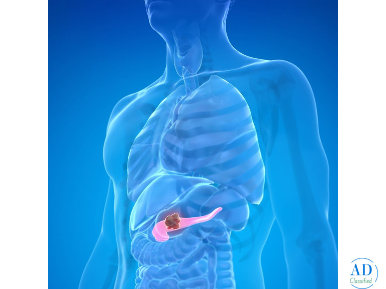 Best Pancreatic Surgeon in India: Expert Care, Better Outcomes