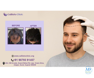 Best Hair Transplant in Surat - Dr. Rushin Thakor-callistoclinic