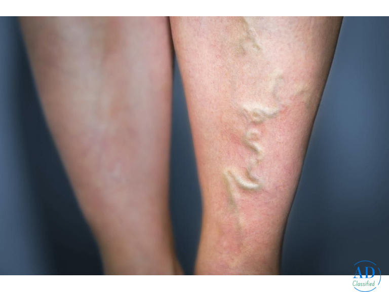 Experienced Varicose Vein Specialist for Advanced Care