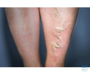 Experienced Varicose Vein Specialist for Advanced Care