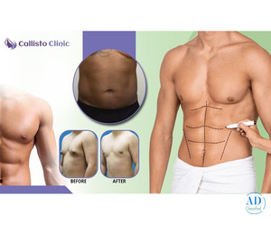 Safe & Effective Liposuction in Surat – Callisto Clinic