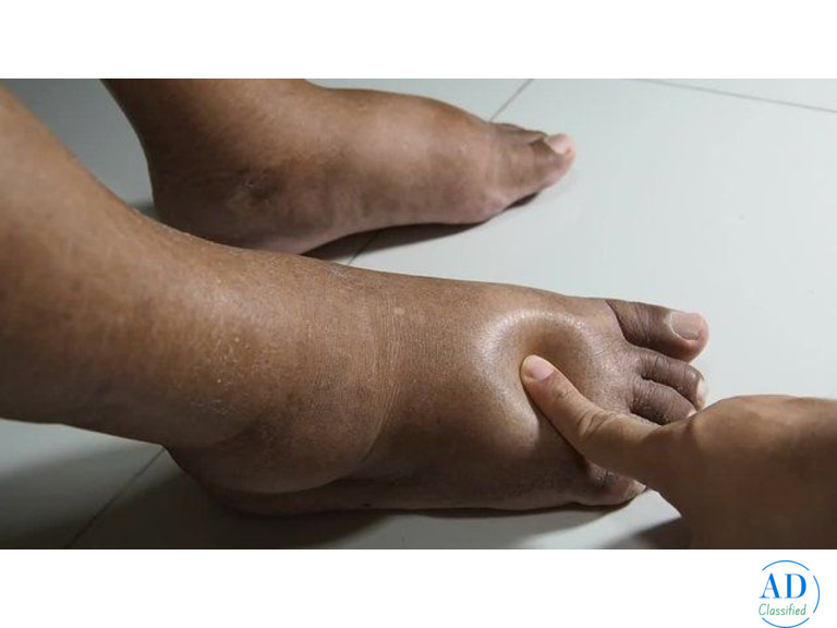 Advanced Diabetic Foot Treatment in Mumbai, India by Dr. Dharav Kheradia