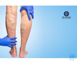 Restore Healthy Legs with Varicose Veins Treatment in Mumbai by Dr. Dharav Kheradia