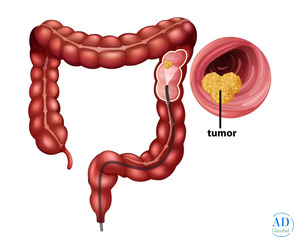 Dr. Shankar Zanwar – Best Treatment for Colon Cancer in Mumbai