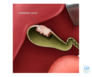 Consult Dr. Shankar Zanwar for Advanced Gallbladder Cancer Treatment in Mumbai