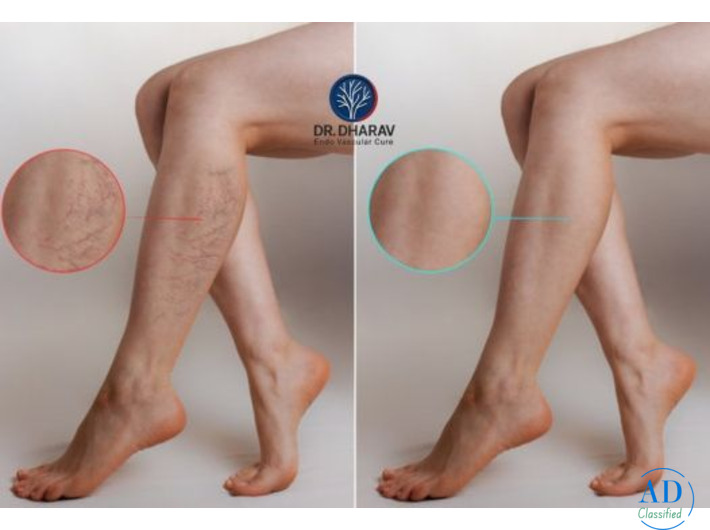 Restore Healthy, Comfortable Legs with Dr. Dharav Kheradia – Varicose Veins Treatment in Mumbai