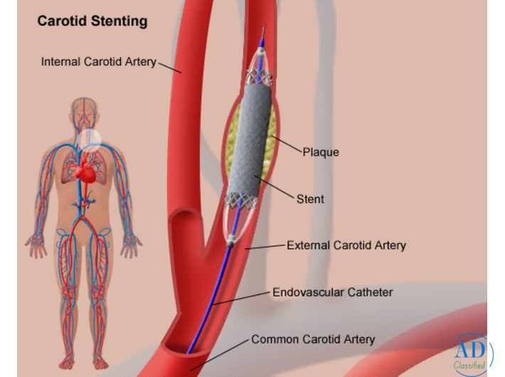 Carotid Artery Stenting: Technique, Indications, and Clinical Outcomes