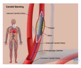 Carotid Artery Stenting: Technique, Indications, and Clinical Outcomes