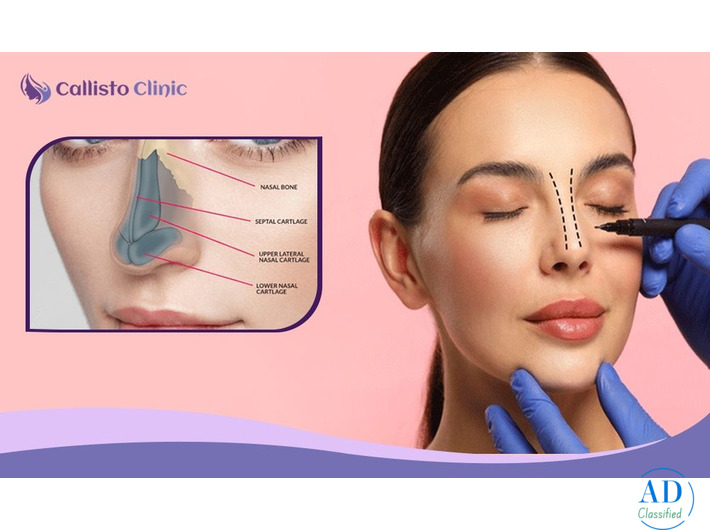 Rhinoplasty Specialists Surat-Callisto Clinic