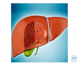 Dr. Chetan Kalal – Best Treatment for Fatty Liver in Mumbai