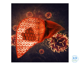 Dr. Chetan Kalal – Liver Cancer Treatment in Mumbai