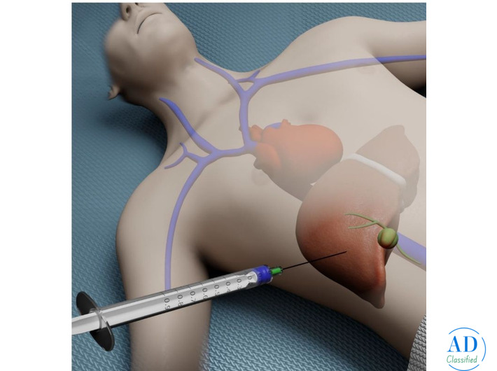 Dr. Chetan Kalal – Best Liver Biopsy Procedure in Mumbai