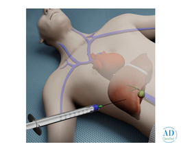 Dr. Chetan Kalal – Best Liver Biopsy Procedure in Mumbai