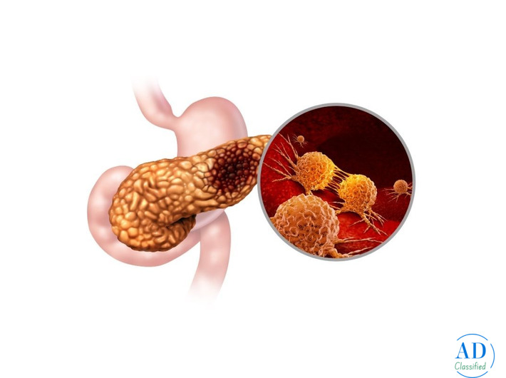 Best Treatment for Pancreatic Cancer in Mumbai by Experienced Specialist