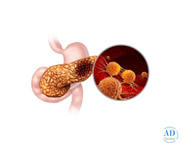 Best Treatment for Pancreatic Cancer in Mumbai by Experienced Specialist