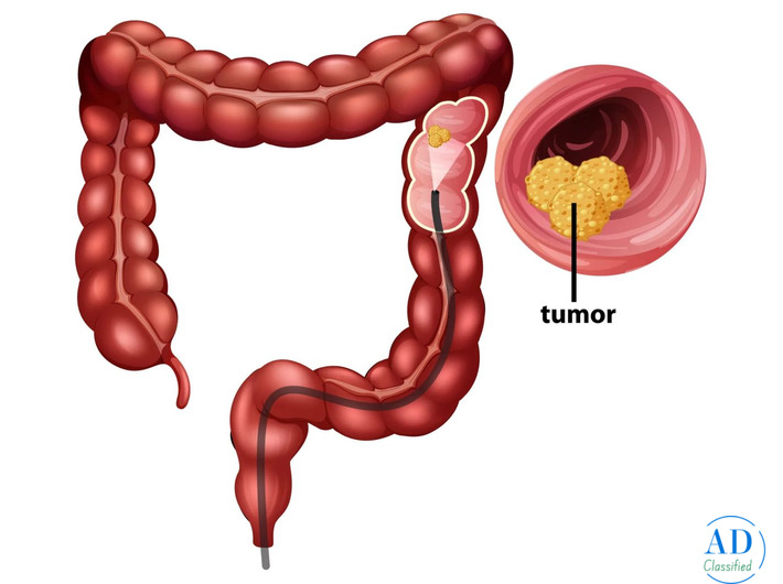 Advanced Treatment for Colon Cancer in Mumbai