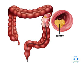 Advanced Treatment for Colon Cancer in Mumbai