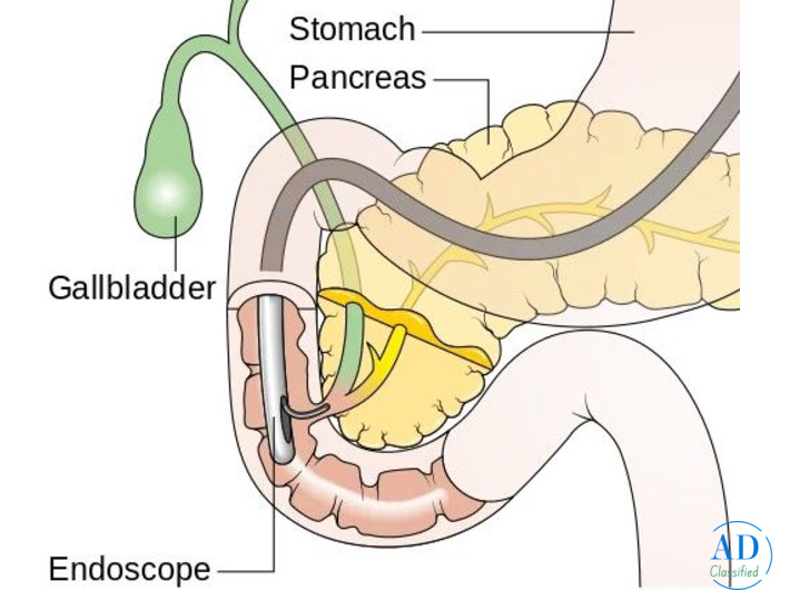 Reliable ERCP Treatment in Mumbai with Advanced Care