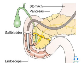 Reliable ERCP Treatment in Mumbai with Advanced Care