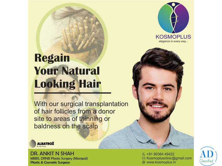 Expert Hair Transplant in Ahmedabad by Skilled Surgeons
