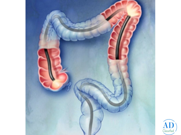 Best Colonoscopy in Mumbai for Accurate Diagnosis