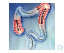 Best Colonoscopy in Mumbai for Accurate Diagnosis