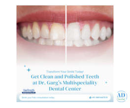 Get Clean and Polished Teeth at Dr. Garg’s Multispeciality Dental Center